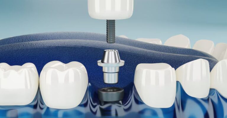 Dental Implants