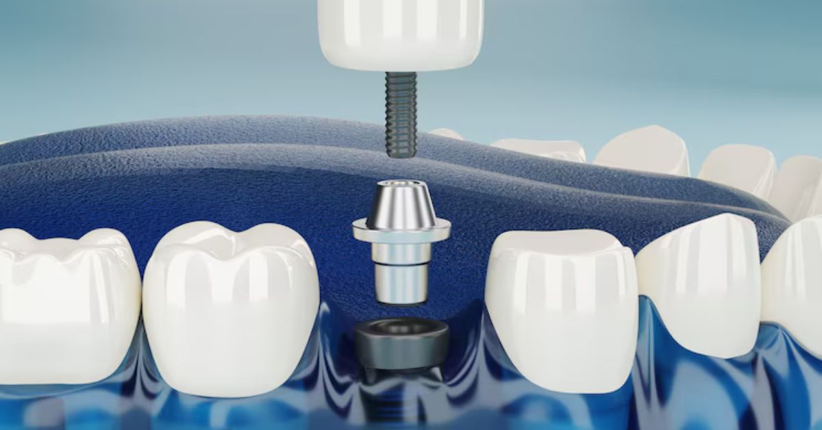 Dental Implants